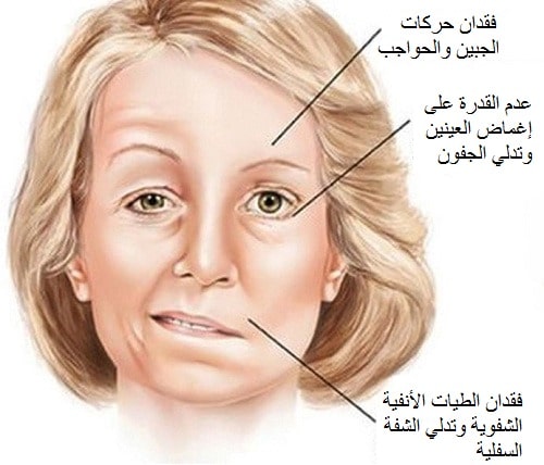 علاج شلل الوجه يتوقف على سبب الإصابة (تواصل اجتماعي)