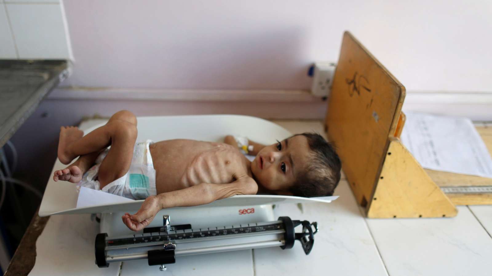 الأمم المتحدة: 2.25 مليون طفل دون الخامسة في اليمن يعانون من سوء تغذية حاد