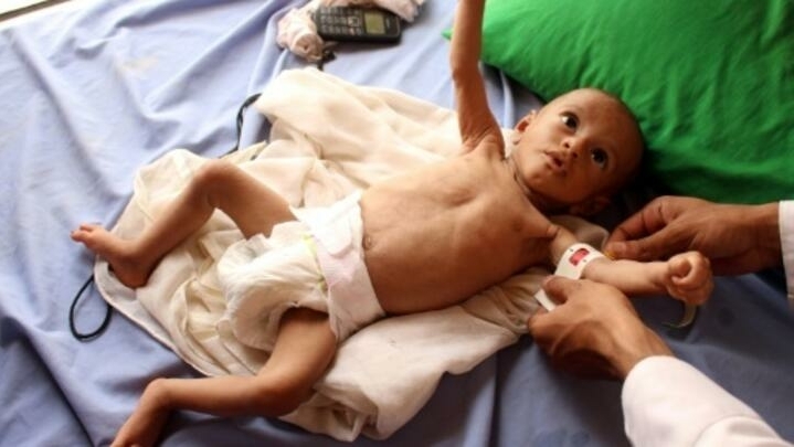 الجوع والحرب والخوف والامراض تعصف بأطفال اليمن ( أرشيفية - ا ف ب)