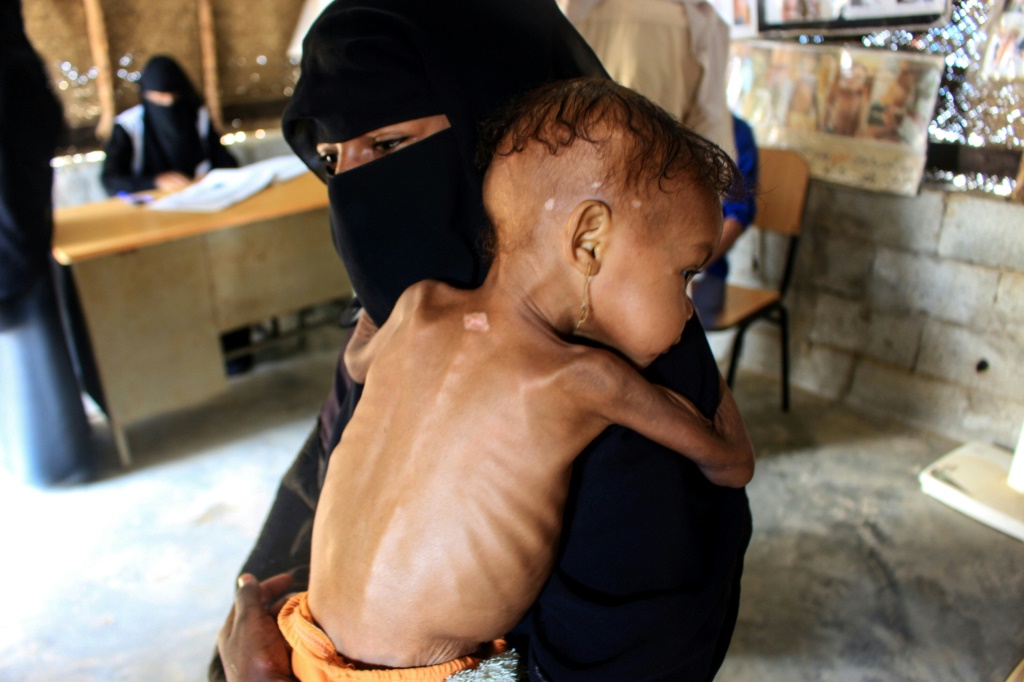 طفلة يمنية صغيرة تعاني من سوء التغذية الحاد تحتجزها والدتها وهي تنتظر العلاج في منشأة طبية في شمال غرب محافظة حجة أواخر العام الماضي (أ ف ب)
