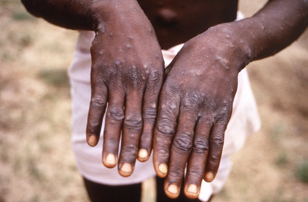 طفح جلدي على يدي رجل أصيب بجدري القردة في جمهورية الكونغو الديموقراطية في 1997 في صورة وزّعتها المراكز الأميركية للسيطرة على الأمراض والوقاية منها. (ا ف ب)