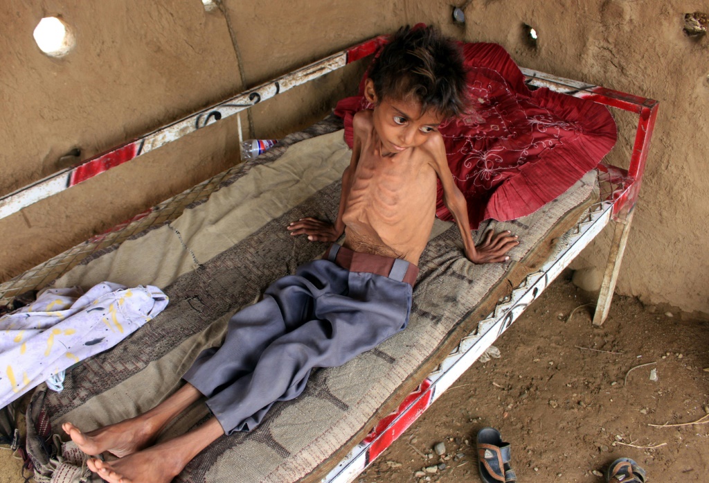  طفل في العاشرة يعاني من سوء تغذية شديد في عبس في اليمن بتاريخ 25 تموز/يوليو 2022 (ا ف ب)