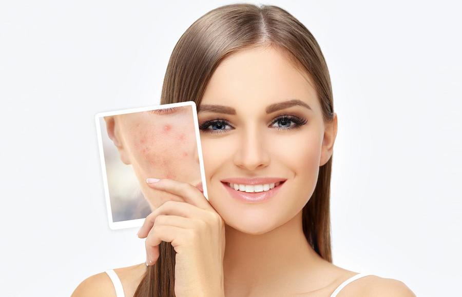 حب الشباب أنواعه وطرق علاجه(سيدتي)