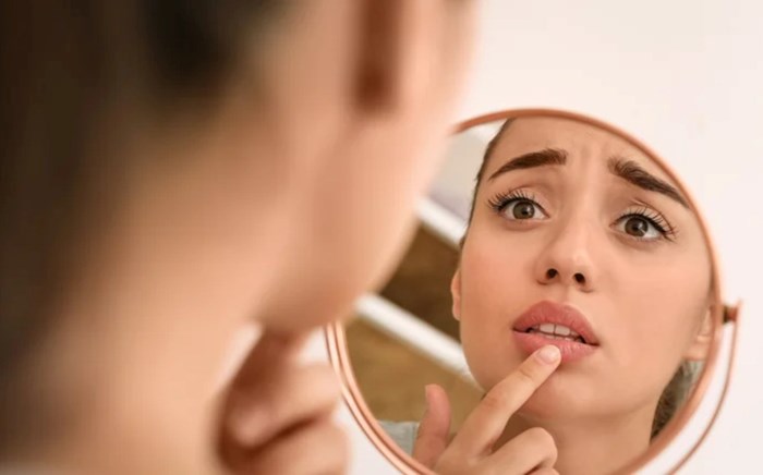 هل تعرضت شفتاك لحروق الشمس؟.. إليك طرق علاج منزلية مجربة(زهرة الخليج)