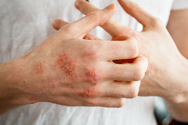 لعلاج الأكزيما.. إليك أفضل وأسوأ العلاجات المنزلية (الاسرة)