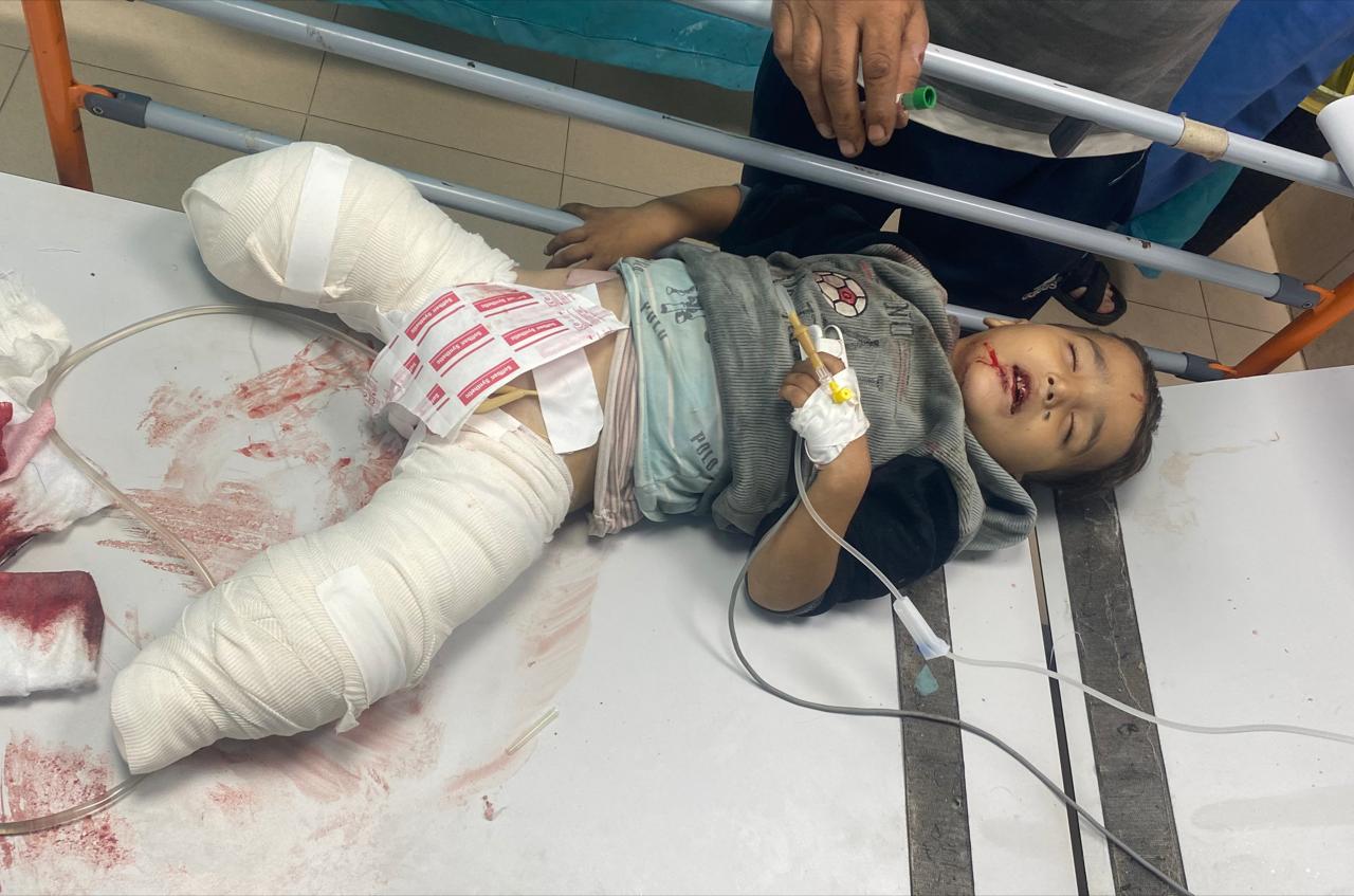 الطفل أحمد شبات (4 سنوات) فقد ساقيه جراء غارة جوية إسرائيلية على مواطنين في مخيم النصيرات&nbsp;(وفا)