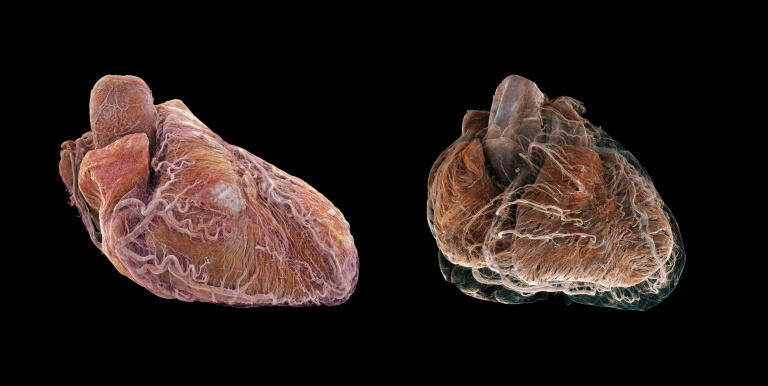 لقطة شاشة ملتقطة في 1 آب/أغسطس 2023 أتاحها الباحث جوزيف برونيه في 17 تموز/يوليو 2024 تظهر صورتين ثلاثيتي الأبعاد لقلب سليم (يسار) وآخر مريض (يمين) في اتجاه تشريحي في غرونوبل بجنوب شرق فرنسا (أ ف ب)
