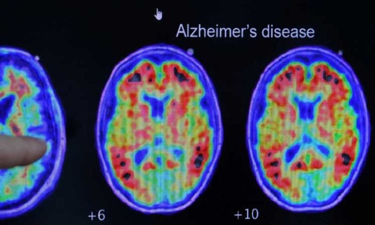 صورة لدماغ بشر مصاب بالزهايمر (أ ف ب)