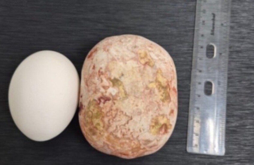 الأطباء يستخرجون (حصوة عملاقة) من مثانة رجل روسي، حساب مستشفى (بولاكوفو) السريري على تلجرام 