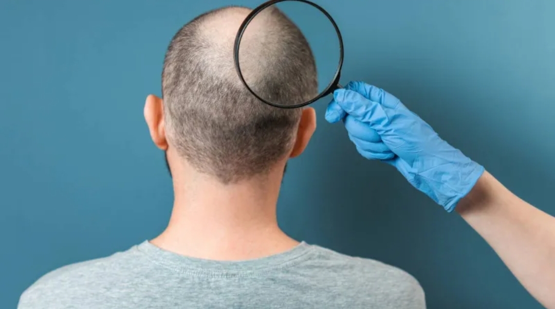 الدواء الأشهر لعلاج الصلع: هل هو آمن على الصحة النفسية؟ (الرجل)