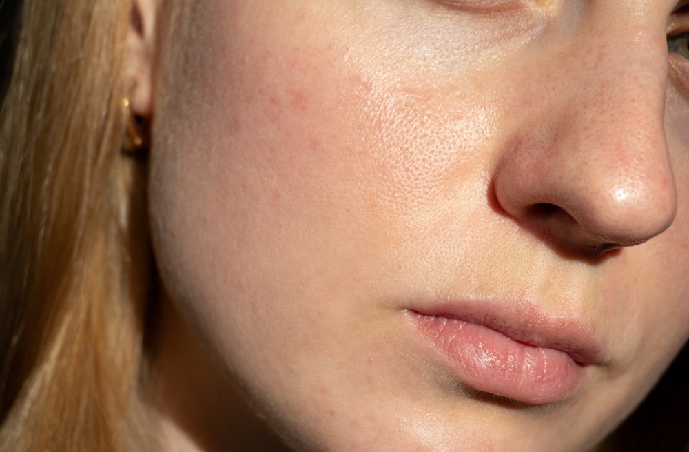 نعم يمكنك السيطرة على البشرة الدهنية.. إليك الطريقة